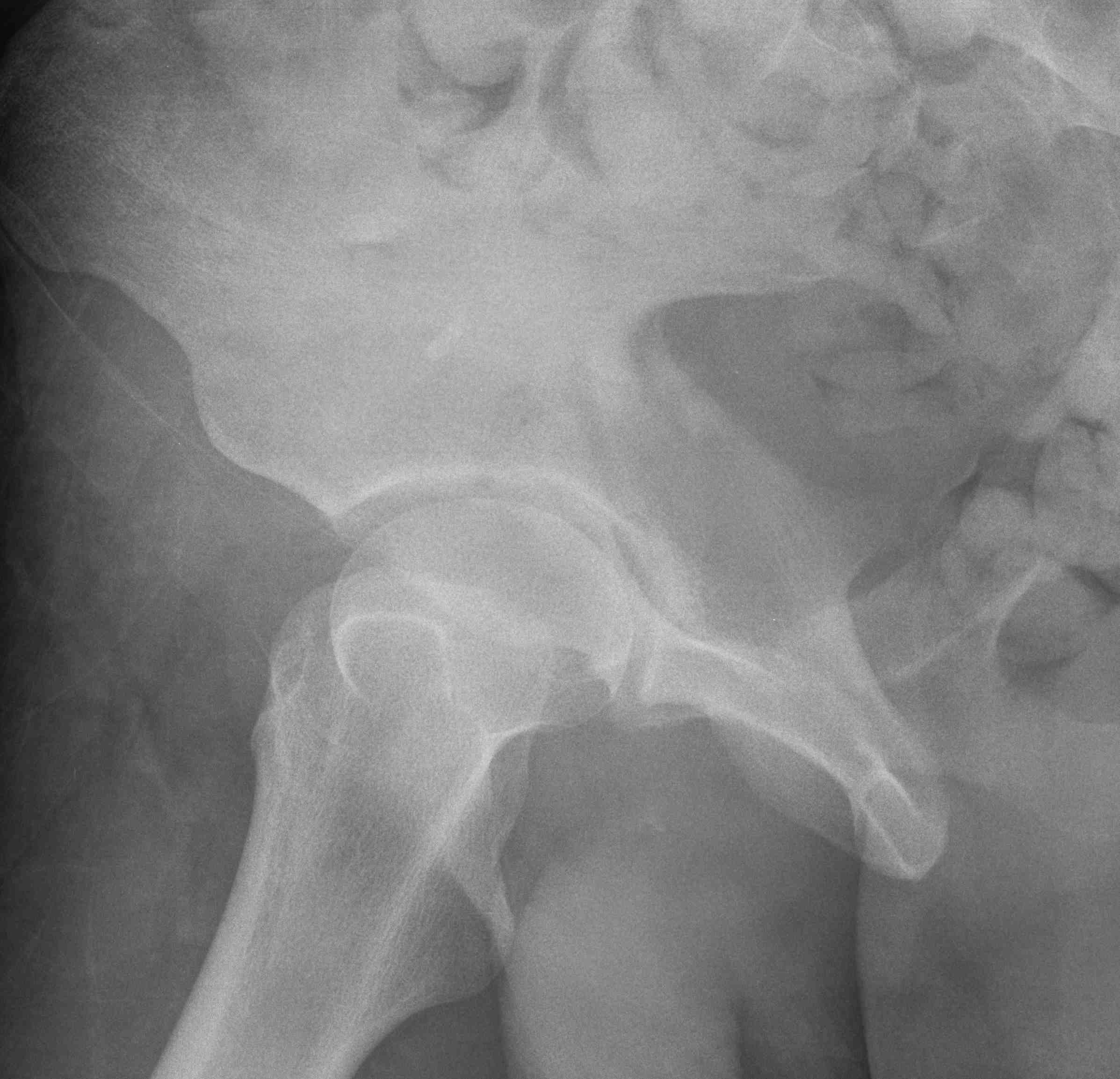 Posterior Column Fracture Xray 2